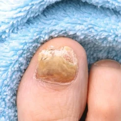 Soins Des Pieds Et Accessoires|Tempsl Teinture pour Onyxis Titania®, 10 ml